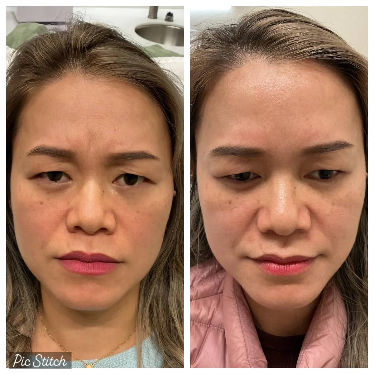 Before and after results of aesthetic treatment at Everis Aesthetic Medicine, patient photo 1
