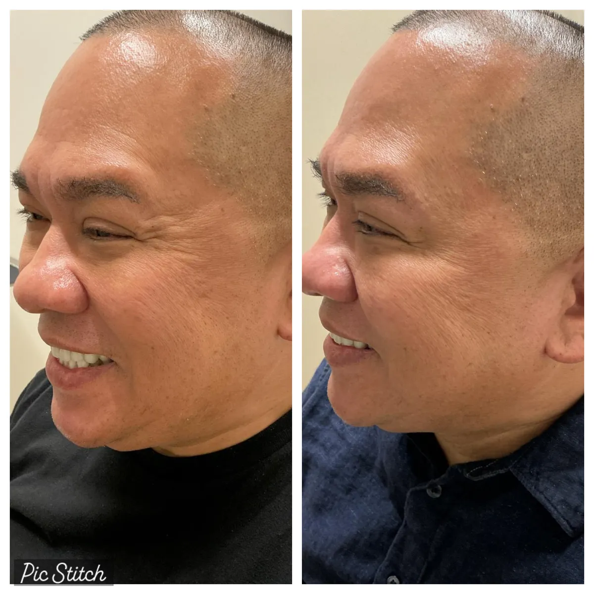 Before and after results of aesthetic treatment at Everis Aesthetic Medicine, patient photo 9