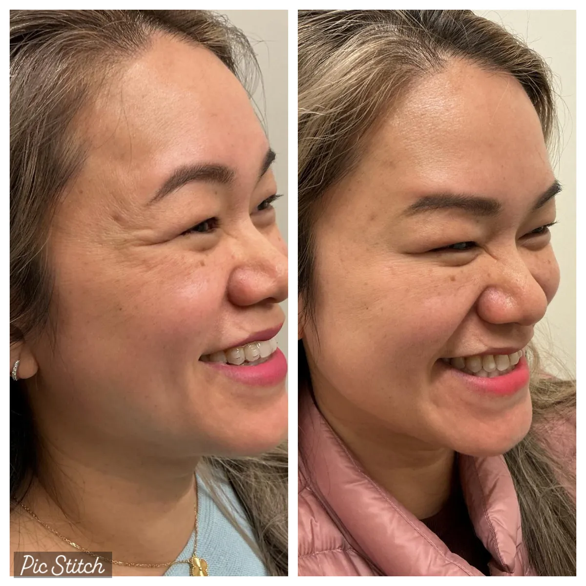 Before and after results of aesthetic treatment at Everis Aesthetic Medicine, patient photo 2