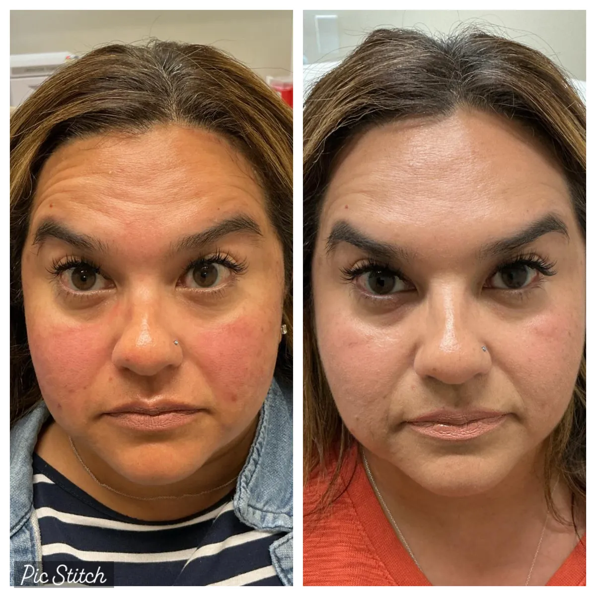 Before and after results of aesthetic treatment at Everis Aesthetic Medicine, patient photo 3