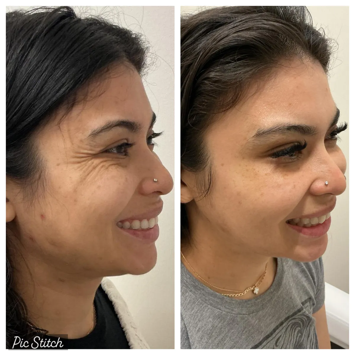 Before and after results of aesthetic treatment at Everis Aesthetic Medicine, patient photo 4