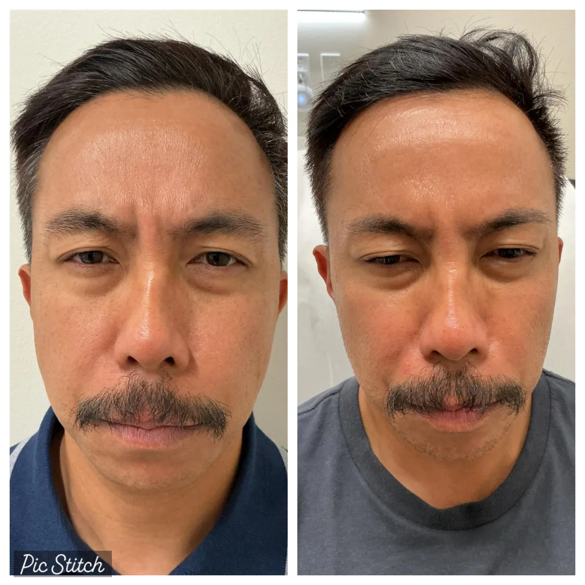 Before and after results of aesthetic treatment at Everis Aesthetic Medicine, patient photo 5