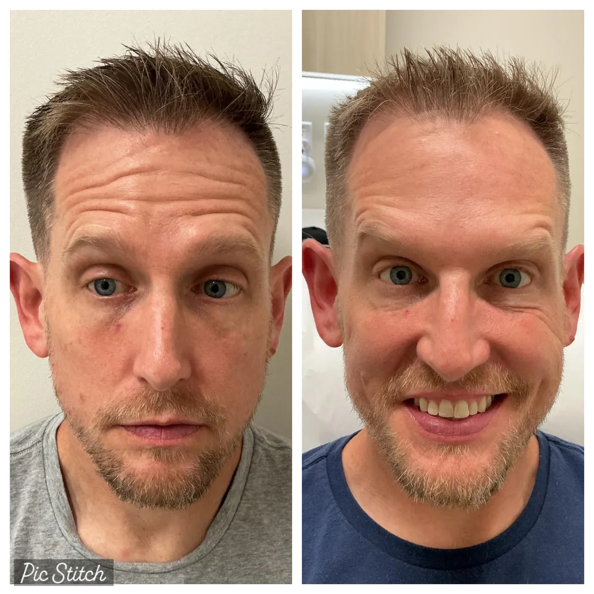 Before and after results of aesthetic treatment at Everis Aesthetic Medicine, patient photo 6