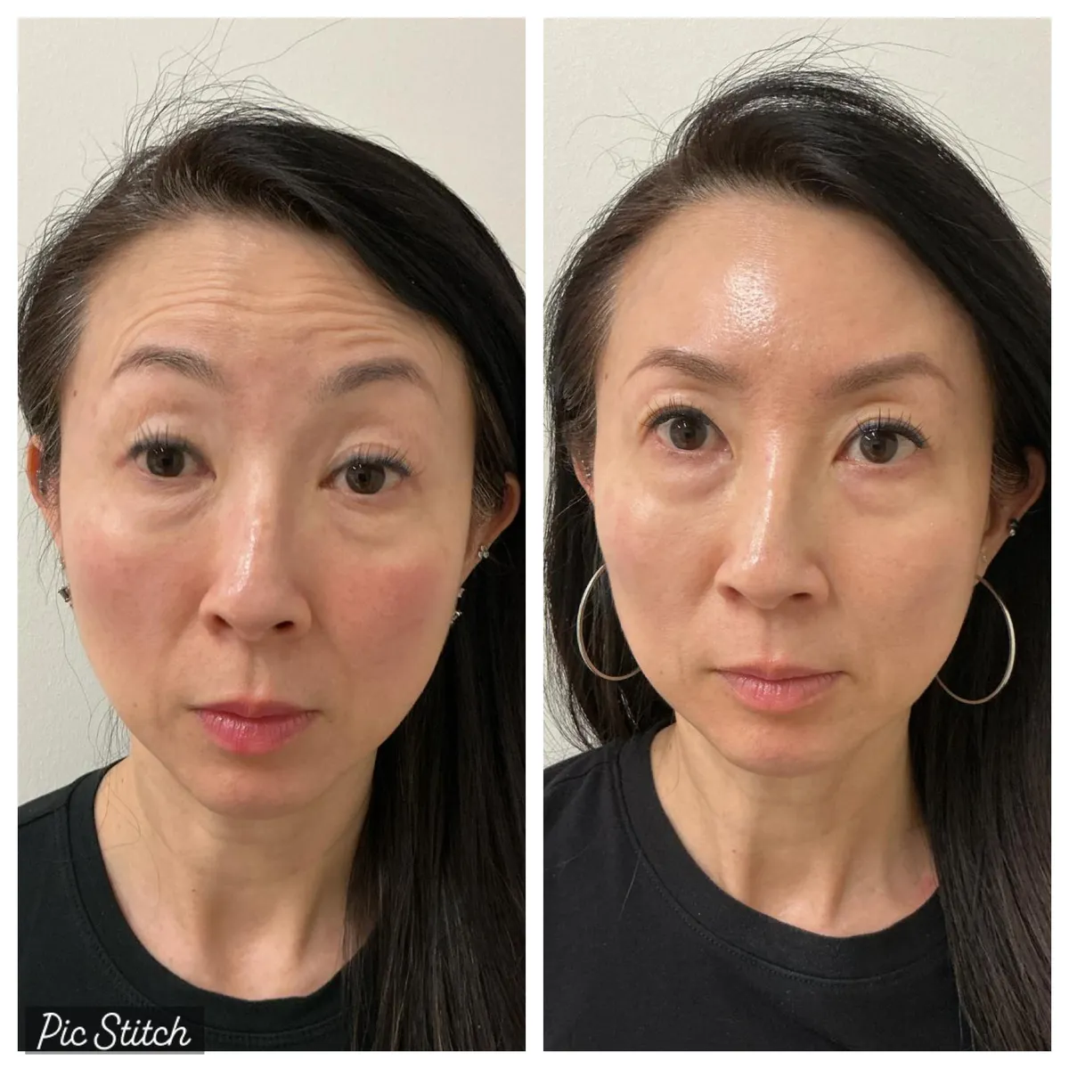 Before and after results of aesthetic treatment at Everis Aesthetic Medicine, patient photo 7