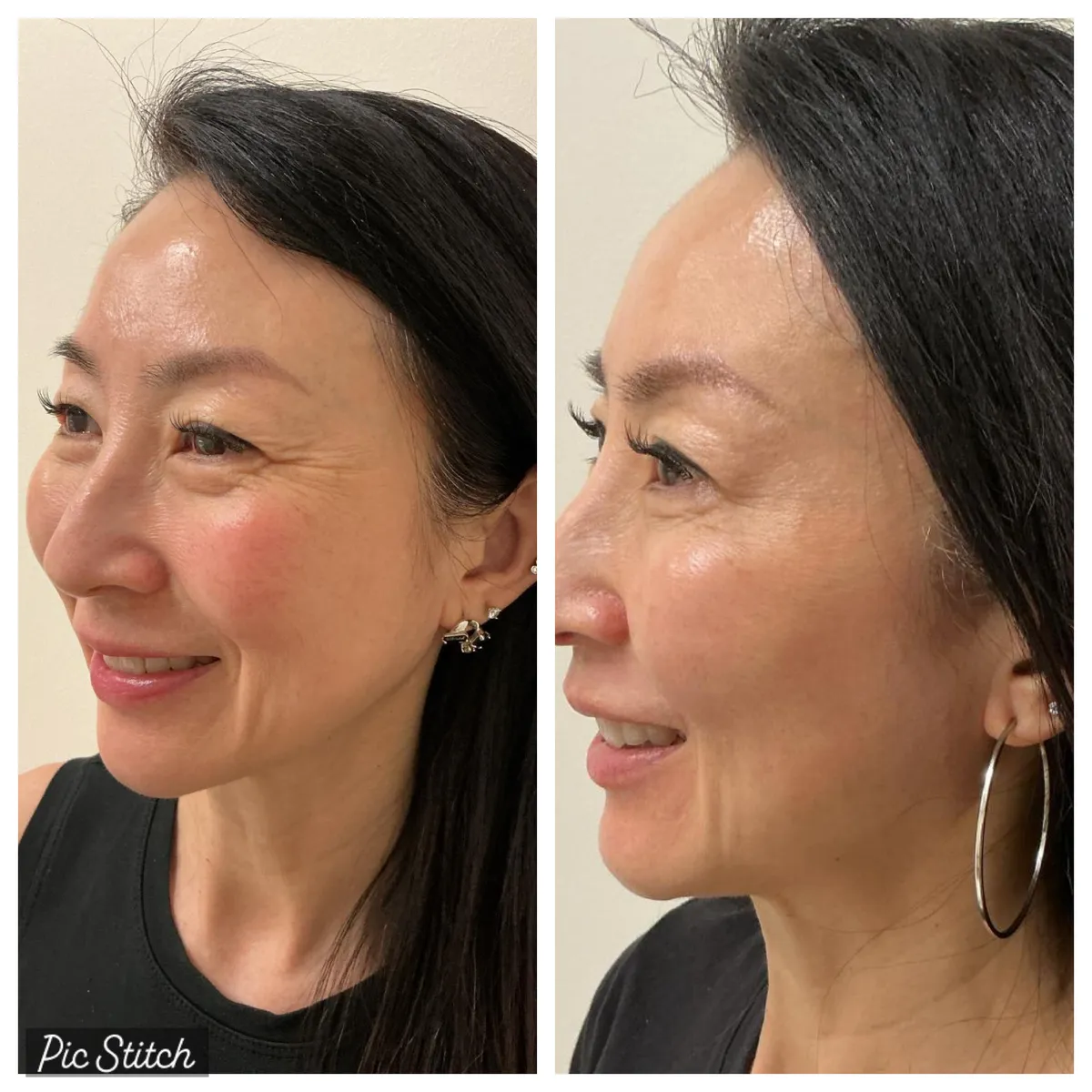 Before and after results of aesthetic treatment at Everis Aesthetic Medicine, patient photo 8
